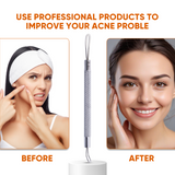 Double Loop Blackhead Remover Pimple Extractor Popper for Acne Comedone Blemish Whitehead Zit Removal Tool