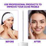 Pimple Extractor Acne Treatment Tool Surgical Grade Blackhead Comedone Removal